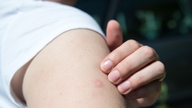 Auf dem Oberarm einer Frau zeichnet sich deutlich ein Mückenstich ab. | Bild: picture-alliance/dpa