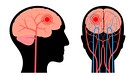 Ein dunkler roter Fleck im Hirn deutet auf der Grafik auf einen Schlaganfall hin.  | Bild: mauritius images / Science Photo Library / Pikovit