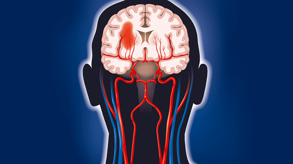 Ein dunkler roter Fleck im Hirn deutet auf der Grafik auf einen Schlaganfall hin.  | Bild: mauritius-images
