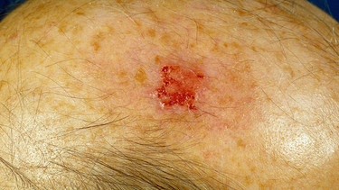 aktinische Keratose durch UV-Bestrahlung auf der Kopfhaut eines Patienten | Bild: picture-alliance/dpa