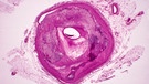 Arteriosklerose unter dem Mikroskop | Bild: picture-alliance/dpa