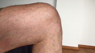 nacktes Knie eines Mannes. | Bild: BR