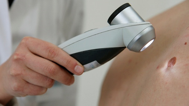 Eine Ärztin untersucht ein Leberfleck mit dem Dermaskop. | Bild: Klinikum rechts der Isar/Michael Stobrawe