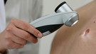 Eine Ärztin untersucht ein Leberfleck mit dem Dermaskop. | Bild: Klinikum rechts der Isar/Michael Stobrawe