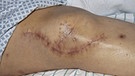 Frische Narbe am operierten Knie nach dem Einsetzen von Implantaten nach einem schweren Verkehrsunfall | Bild: picture-alliance/dpa