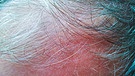 graue Haare, kahle Stellen | Bild: colourbox.com
