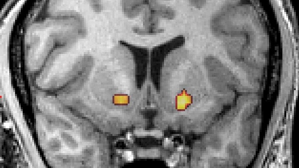 Die Kernspinthomographie zeigt ein Hirnschnittbild, auf dem Nervenzellenaktivitäten, die zum Beispiel beim Glücksspiel aktiv sind, gelb gekennzeichnet wurden.  | Bild: picture-alliance/dpa