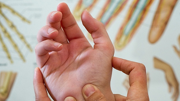 Die sog. Sattelgelenksathrose ist eine häufige Form der Gelenksarthrose in der Hand. Im Bild: Eine Hand wird therapiert. | Bild: picture-alliance/dpa