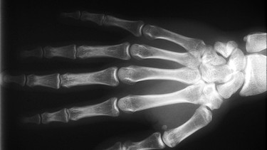 Um eine Handverletzung diagnostizierren zu können, wird ein Röntgenbild gemacht, manchmal zusätzlich noch eine Kernspintomographie. Im Bild: Röntgenaufnahme einer Hand.  | Bild: picture-alliance/dpa
