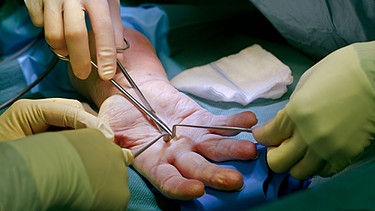 In der Handchirurgie wurden in den letzten Jahren erstaunliche Fortschitte gemacht. Im Bild: Operation an einer Hand. | Bild: picture-alliance/dpa