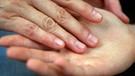 Die Dupuytrensche Kontraktur ist eine gutartige Wucherung in der Handinnenfläche. Im Bild: Eine Frau legt ihre Hand in eine Handinnenfläche  | Bild: picture-alliance/dpa