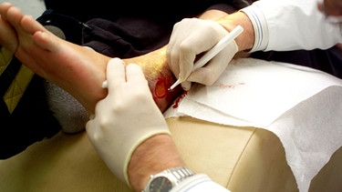 Arzt bei der Behandlung von sog. Hautgefäßschäden am Bein eines Patienten | Bild: picture-alliance/dpa