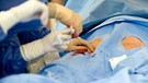 Einsetzen einer Herzklappe durch minimal-invasives Verfahren am Herzzentrum Dresden | Bild: picture-alliance/dpa