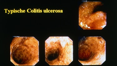 Kolitis ist eine sehr gefährliche Entzündung des Darms. Im Bild: Aufnahme einer Kolitis | Bild: picture-alliance/dpa