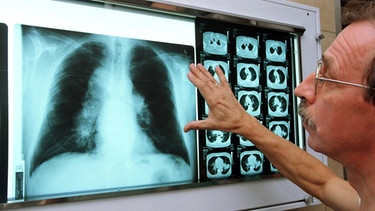 Arzt vor einem Röntgenbild der Lunge | Bild: picture-alliance/dpa