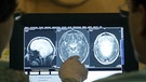 Aufnahme eines lädierten Gehirns aus einem Kernspintomographen | Bild: picture-alliance/dpa