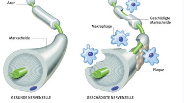 Gesunde und durch MS geschädigte Nervenzelle im Vergleich | Bild: picture-alliance/dpa