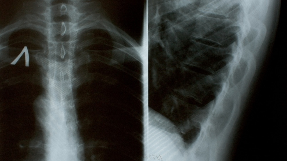 Röntgenbild eines Knochens mit Osteoporose | Bild: colourbox.com