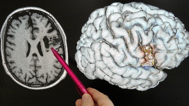 Ein Schlaganfall lässt sich so nachweisen: An einer Schichtaufnahmen eines Gehirns, die mit einem Magnetresonanztomographen aufgenommen worden ist, zeigt ein Arzt auf einen Bereich, der durch einen Schlaganfall geschädigt ist.  | Bild: picture-alliance/dpa