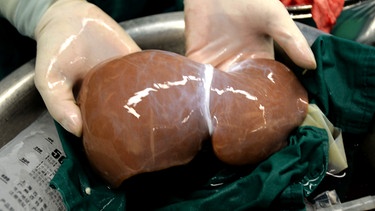 Organtransplantation | Bild: picture-alliance/dpa