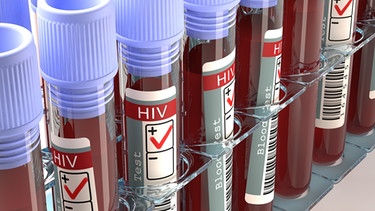 Symbolbild: Blutproben mit den Ergebnis "HIV positiv" | Bild: colourbox.com