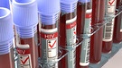 Symbolbild: Blutproben mit den Ergebnis "HIV positiv" | Bild: colourbox.com