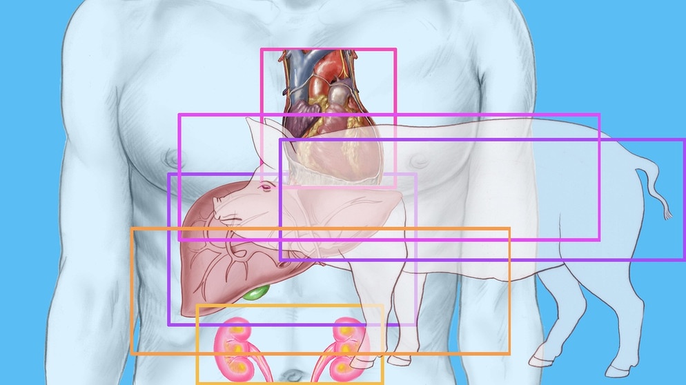 Graphische Überlagerung eines menschlichen Oberkörpers mit Herz, Magen und Nieren und dem Abbild eines Schweins.  | Bild: picture-alliance/dpa
