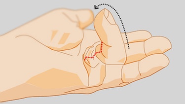 Illustration: Darstellung eines gekrümmten Fingers | Bild: BR/Tanja Begovic