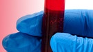 Hand hält Reagenzglas mit Blut | Bild: colourbox.com; Montage: BR