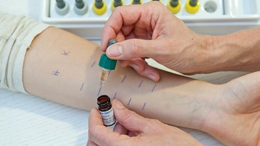 Durchführung eines Allergietests am Unterarm | Bild: picture-alliance/dpa