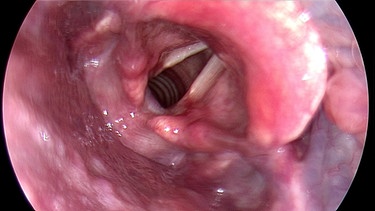 Die Stimmritze ist erweitert, der Mensch atmet. | Bild: Quelle: Klinikum Augsburg/Hals-Nasen-Ohren-Klinik