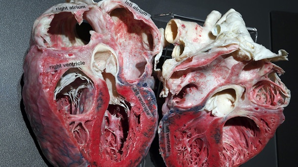 Querschnitt durch das menschliche Herz. Präparat aus dem Körperwelten-Museum | Bild: picture-alliance/dpa
