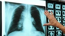 Röntgenbild einer Lunge | Bild: picture-alliance/dpa
