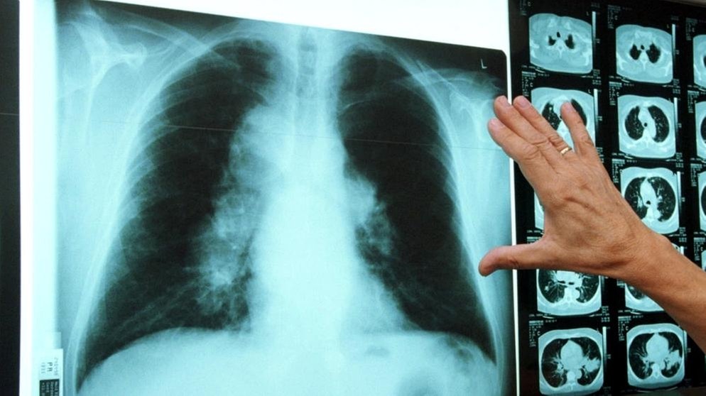 Röntgenbild einer Lunge | Bild: picture-alliance/dpa