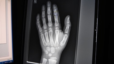 Hand eines Jugendlichen im Röntgenbild | Bild: picture-alliance/dpa