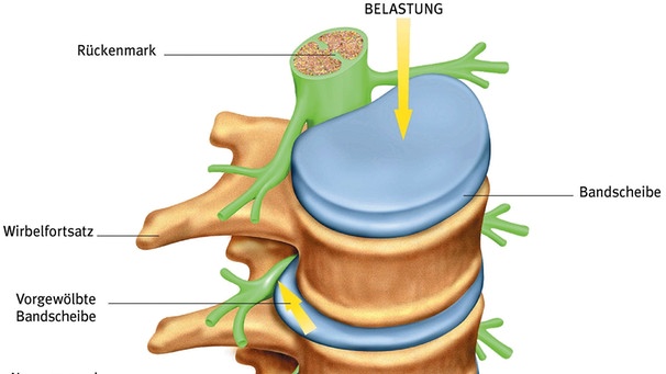 Die Illustration zeigt die Lage der Bandscheibe zwischen den Rückenwirbeln | Bild: picture-alliance/dpa