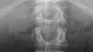Röntgenbild einer menschlichen Wirbelsäule | Bild: picture-alliance/dpa