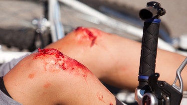 blutiges Knie nach Fahrradunfall | Bild: colourbox.com
