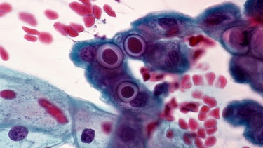 Vergrößerte Aufnahme von Chlamydia trachomatis Erregern in Epithelzellen der Gebärmutterschleimhaut  | Bild: picture-alliance/dpa