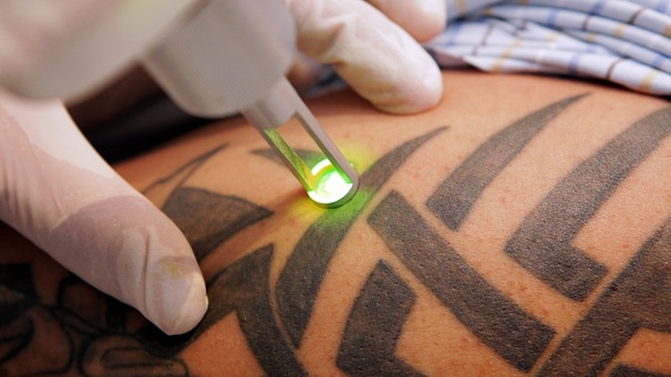 Ein Mann lässt sich mittels Laser eine Tätowierung entfernen. | Bild: picture-alliance/dpa