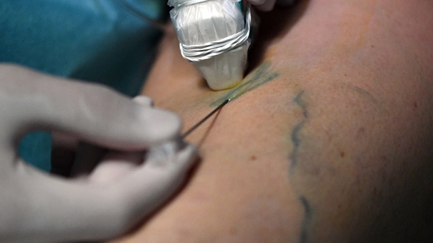 Ein Arzt punktiert mit Hilfe von Ultraschall ein Gefäß. | Bild: picture-alliance/dpa