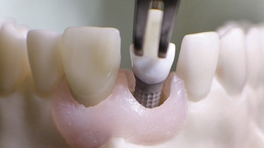 Ein Künstlicher Zahn wird mit einer Zange auf ein Implantat gesetzt. | Bild: picture-alliance/dpa