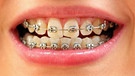 Eine feste Zahnspange sitzt auf zwei sichtbaren Zahnreihen. | Bild: Colourbox