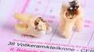 Ein gezogener, kariöser Zahn liegt auf einem Kostenvoranschlag für eine künstliche Krone. | Bild: colourbox.com