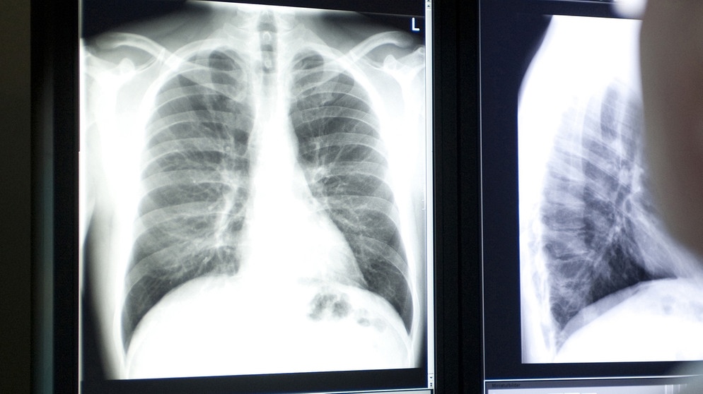 Arzt betrachtet Röntgenbild einer Lunge. | Bild: picture-alliance/dpa/ Fotograf: Greenwood