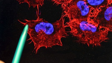 Eine Doktorandin schaut im Labor auf einen Monitor, auf dem ein Bild von Melanom-Zellen (schwarzer Hautkrebs) zu sehen ist. | Bild: dpa-Bildfunk/Bernd Wüstneck